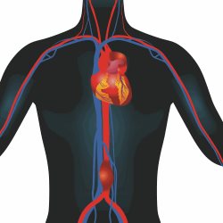 Photo6_aneurysmgraphic-(1).jpg Photo6_aneurysmgraphic-(1).jpg